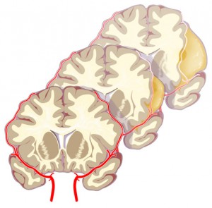 Cerebral Cyst