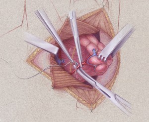 Thryoidectomy